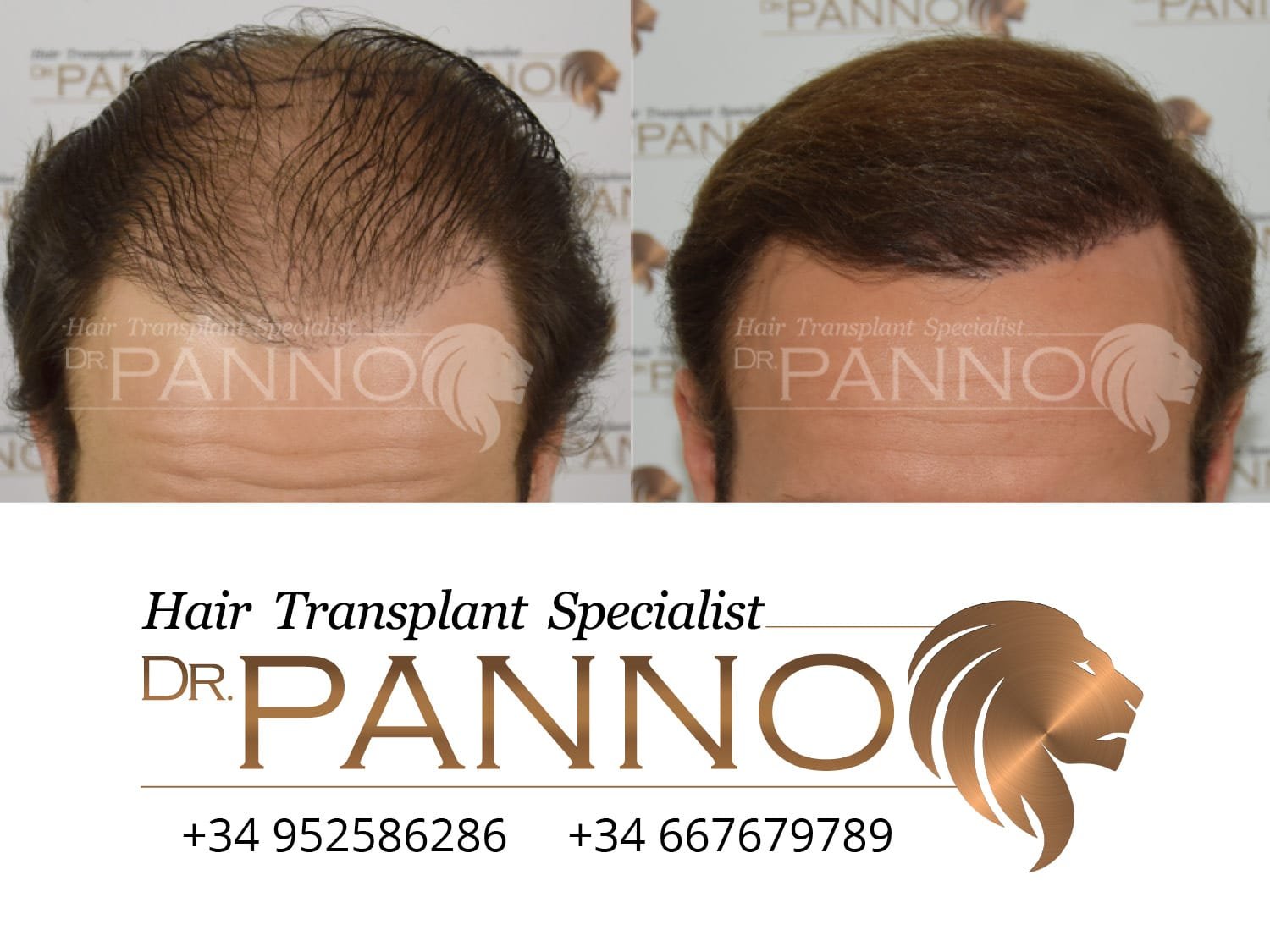 The Results of Hair Transplant in Patients of Dr. Panno