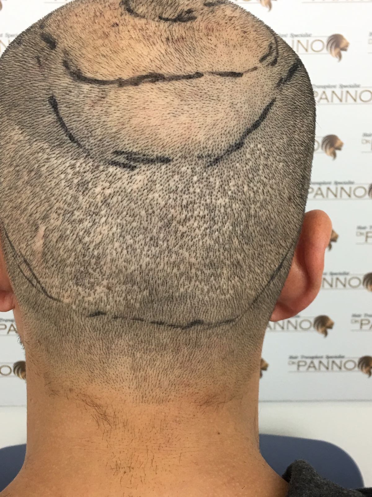 Un Injerto Capilar, ¿Se Puede Reparar?