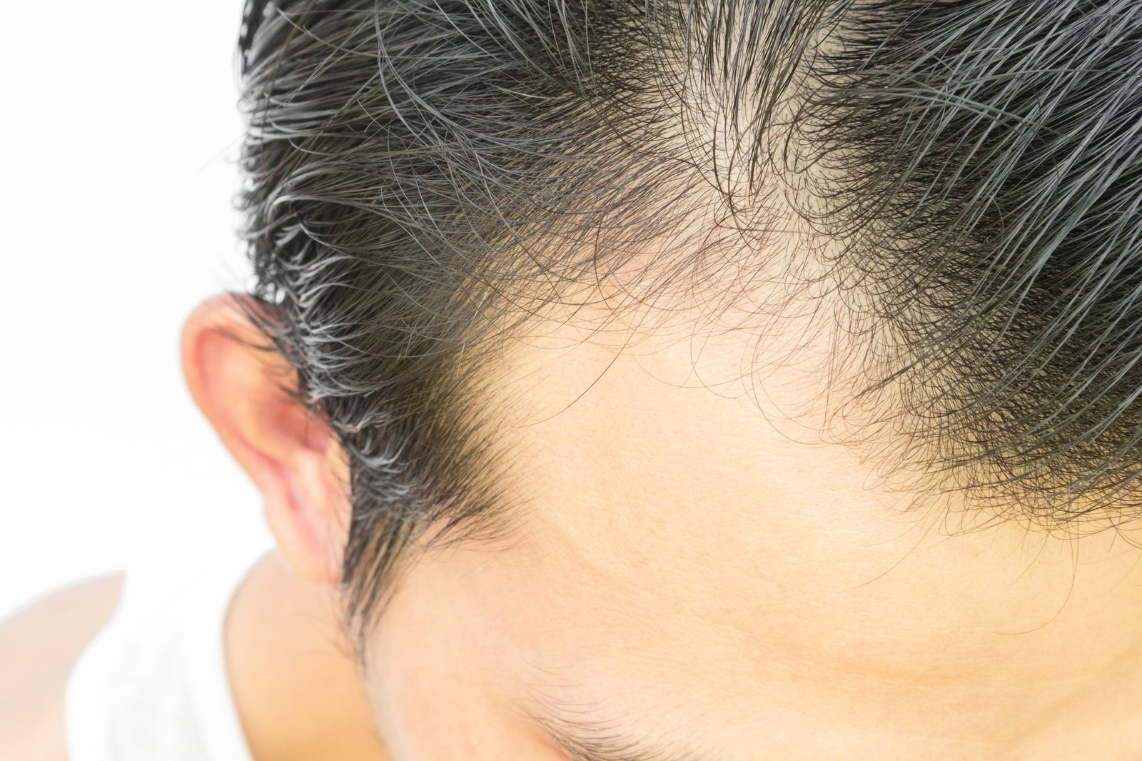 Hair Transplant In Spain: Get Hair Without Going To Turkey