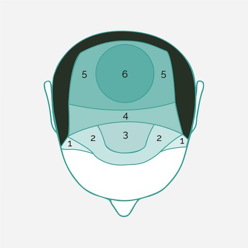 injerto capilar top view