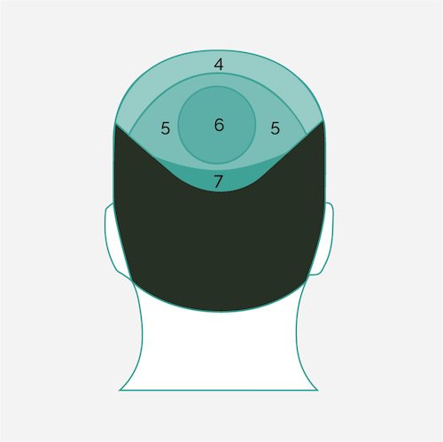 injerto capilar diagram back view