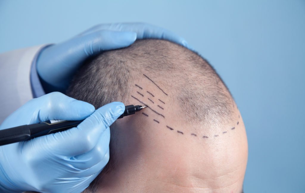Patient suffering from hair loss in consultation with a doctor.
