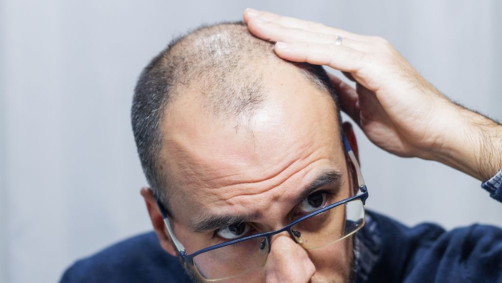 Alopecia and self-esteem, is there a relationship?