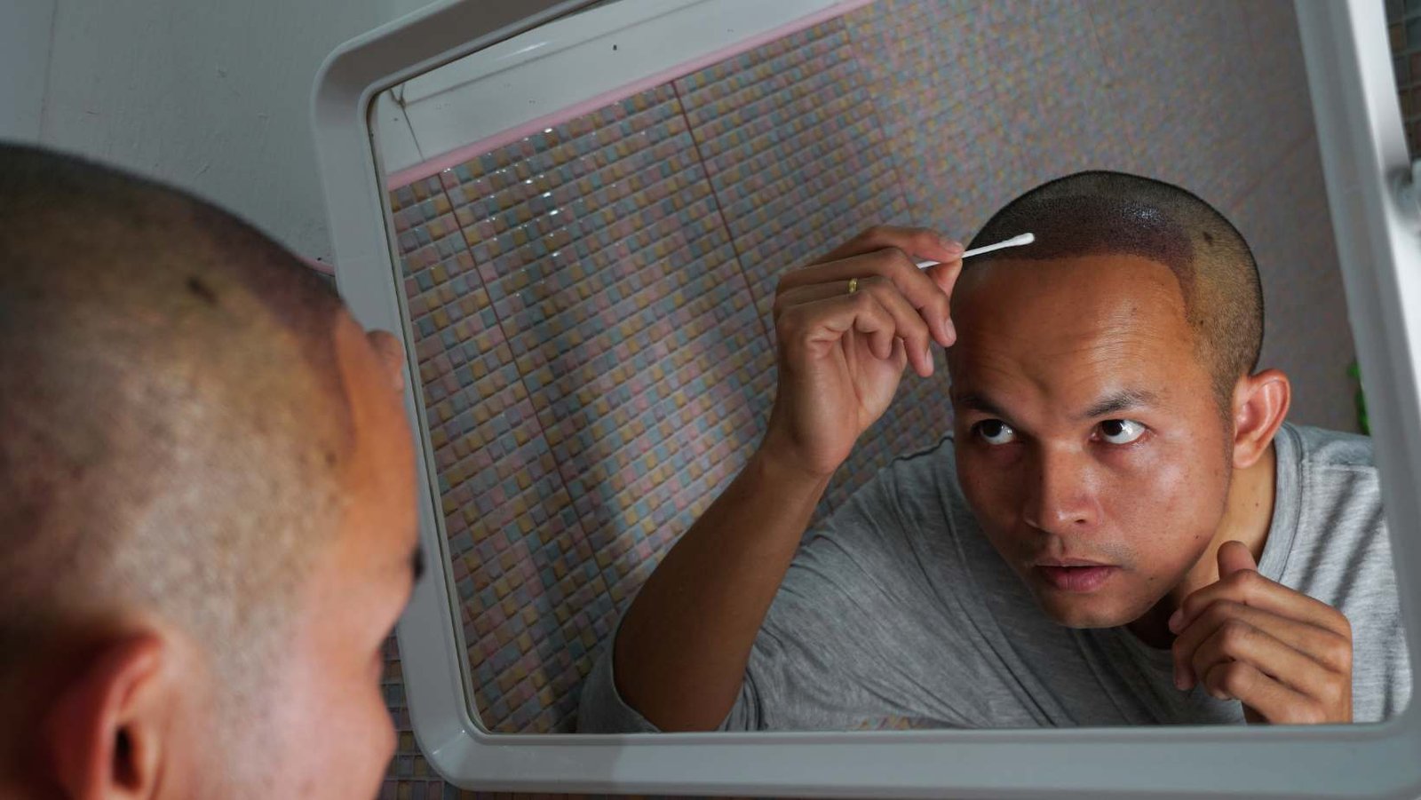 Hair Transplant and Aftercare