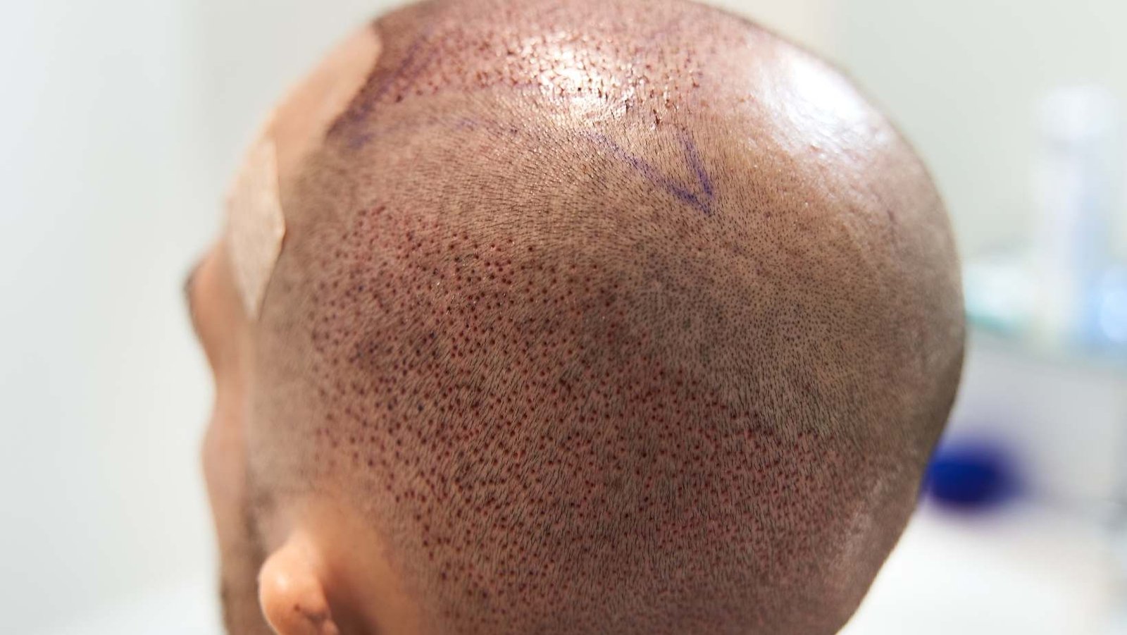 Hair Areas to Repopulate