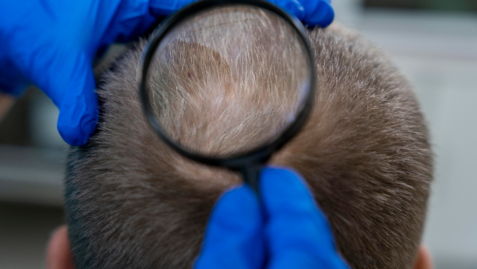 Hair transplants for patients with alopecia areata