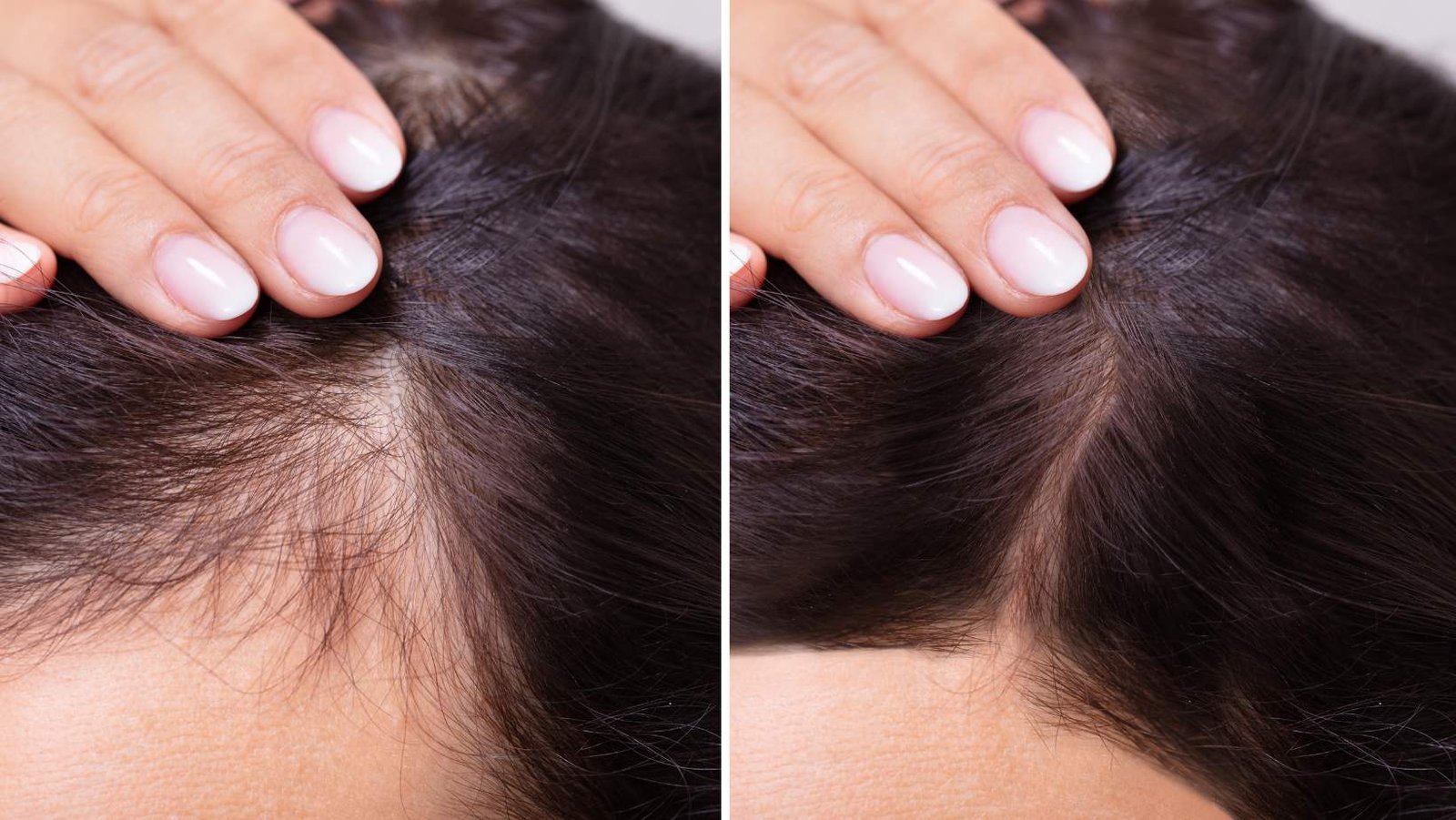 Can you grow hair again after severe hair loss?