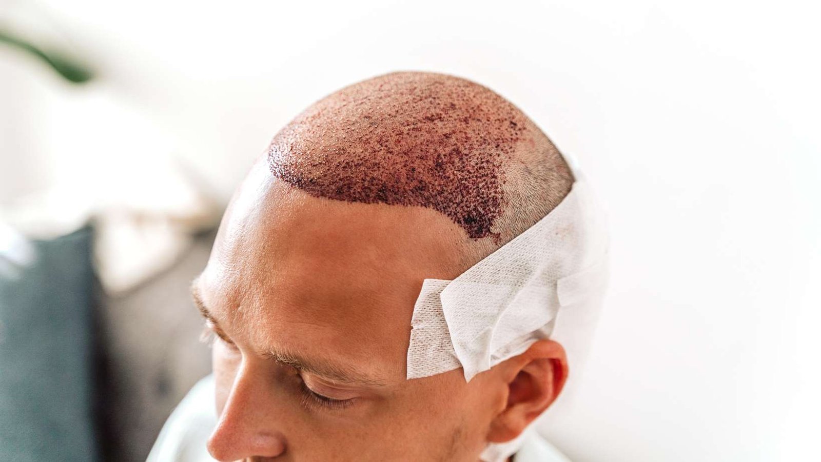 Post-hair transplant care during winter