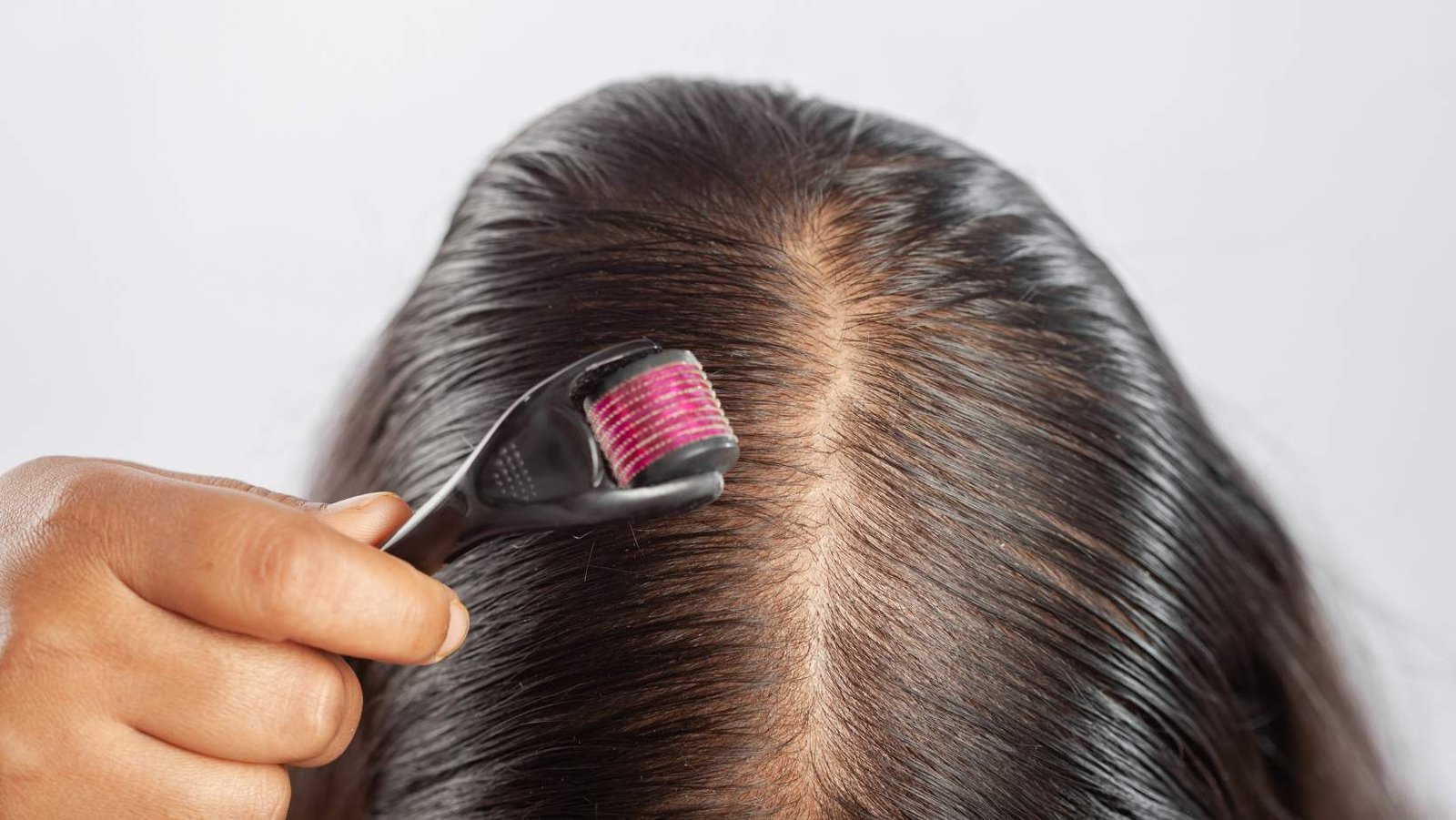 Ritlecitinib: primer tratamiento oral para alopecia areata en adolescentes